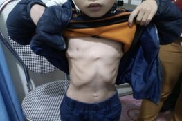 Child Surgery Vietnam maakt een einde aan operatie achterstanden bij kinderen